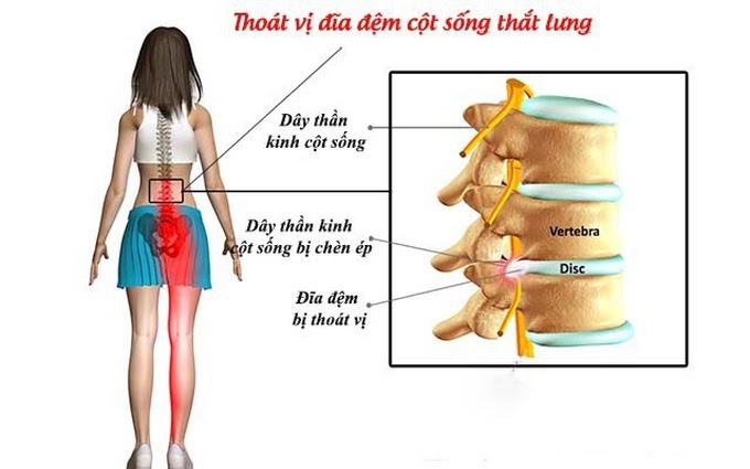 cách chữa thoát vị đĩa đệm cột sống thắt lưng