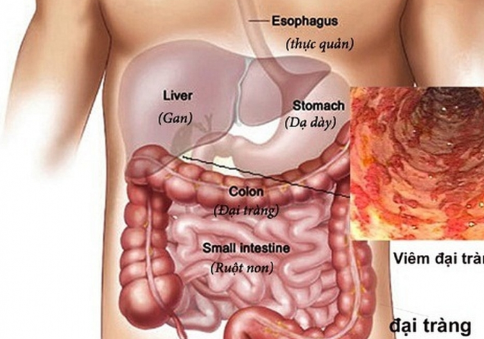 đau bụng quặn từng cơn vùng xung quanh rốn do viêm đại tràng